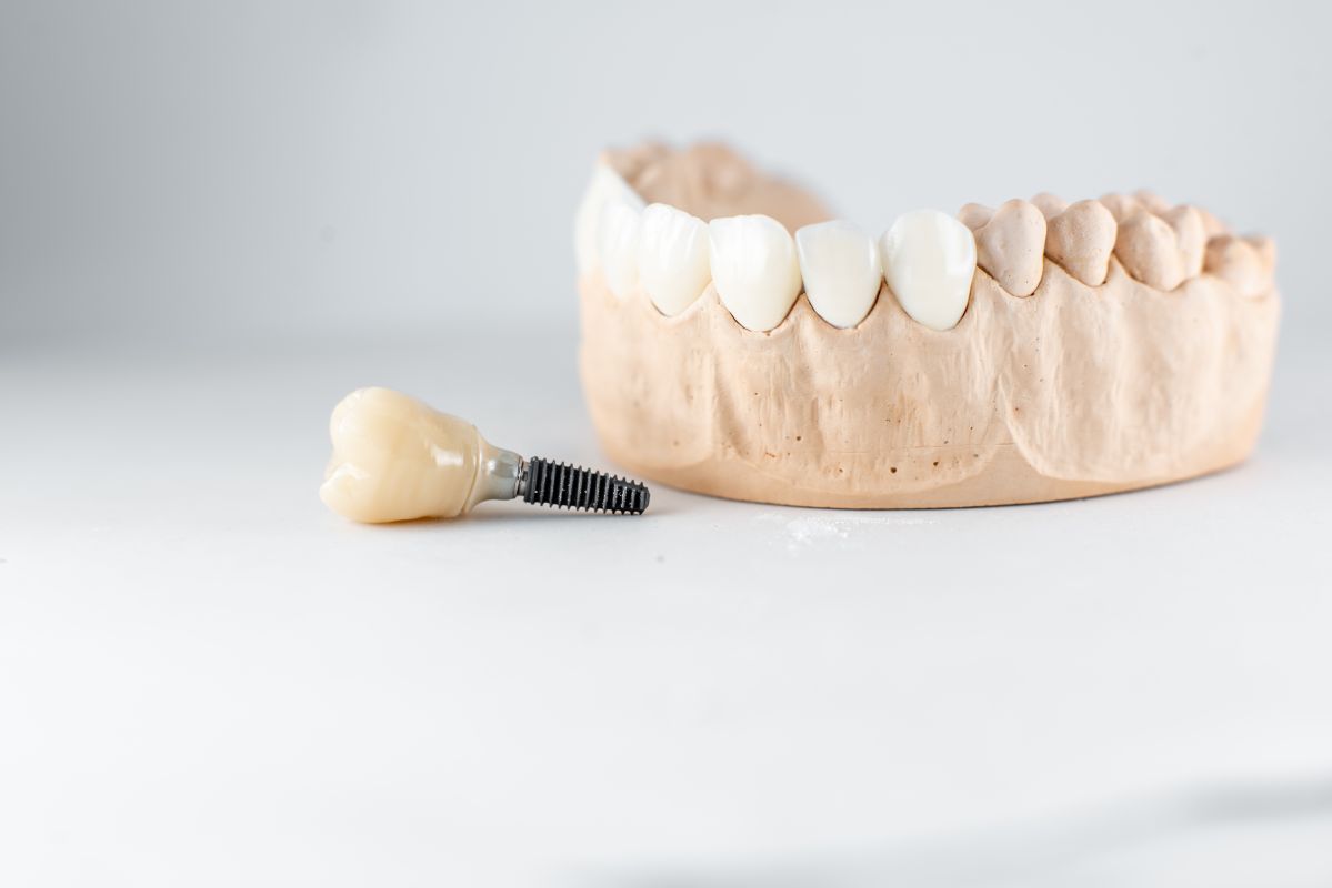 Implanty Zębów Powikłania Po Zabiegu 6974