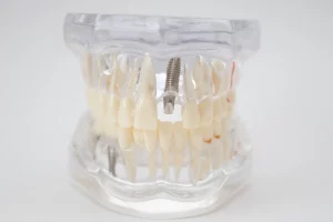 Stan zapalny po wszczepieniu implantu zęba